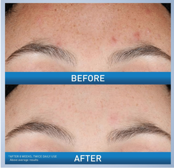 CERAVE RESURFACING RETINOL SERUM TO REDUCE THE APPEARANCE OF POST-ACNE MARKS AND PORES WITH RETINOL, LICORICE ROOT EXTRACT & NIACINAMIDE 30ML - Image 2