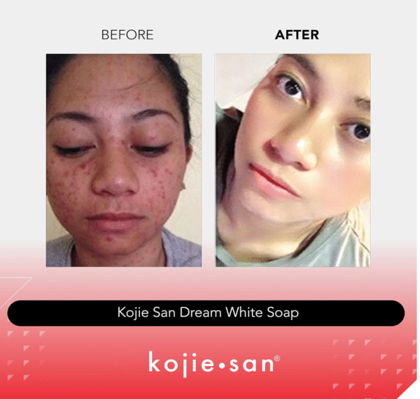 Kojie San Original Kojie San Dream White Soap 65g, 2 Bars Per Pack - Guaranteed Authentic - Image 4