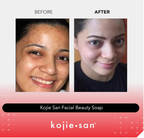 Kojie San Original Facial Beauty Soap - 65g, 3 Bars Per Pack - Guaranteed Authentic - Image 8